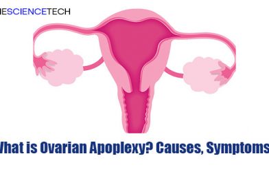 What is Ovarian Apoplexy? Causes, Symptoms?